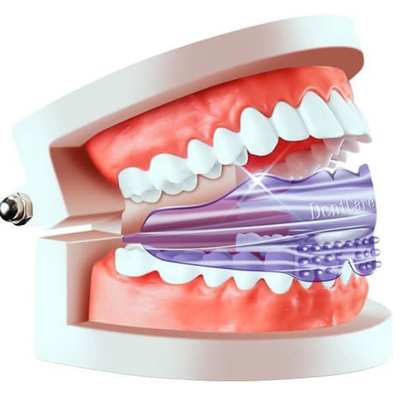 סד חדשני ליישור שיניים ומניעת חריקות