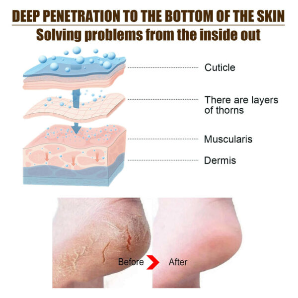 חמאה טיפולית להסרת עור יבש וסדוק מכפות הרגליים
