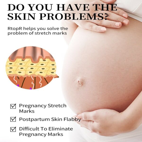 קרם מנגו ייחודי לטיפול בסימני מתיחה ועור רפוי במהלך ולאחר הריון