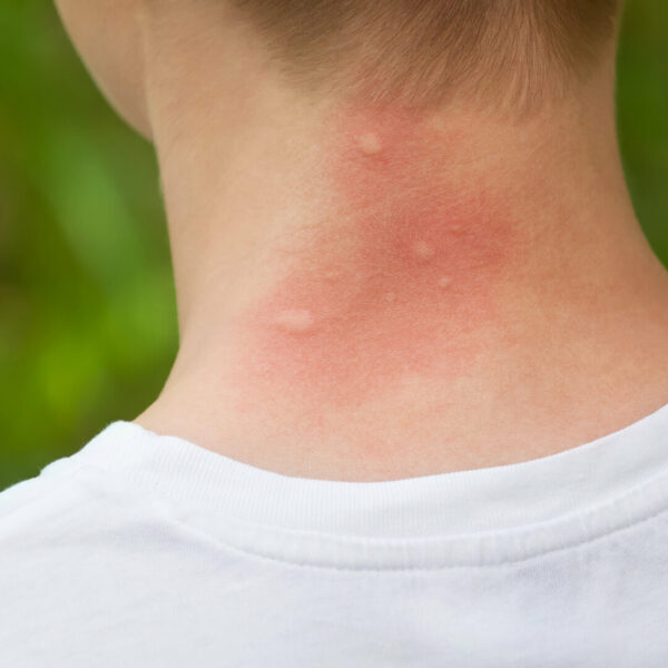 מדבקות ילדים להרחקת יתושים וחרקים