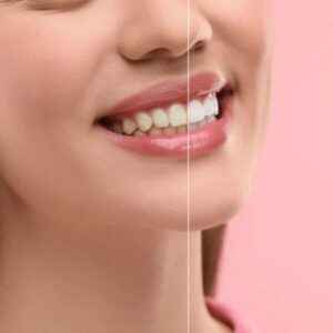 משחת שיניים BODYAID להלבנה, ניקוי עמוק ומניעת ריח רע